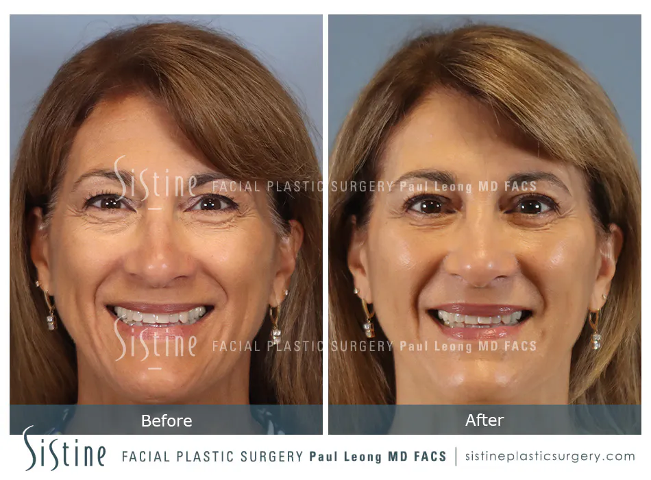 Blepharoplasty Before and After | Leong Facial Plastic Surgery