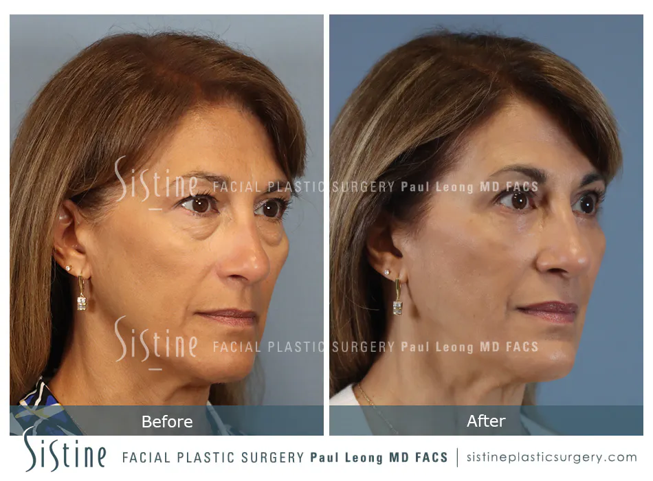 Blepharoplasty Before and After | Leong Facial Plastic Surgery