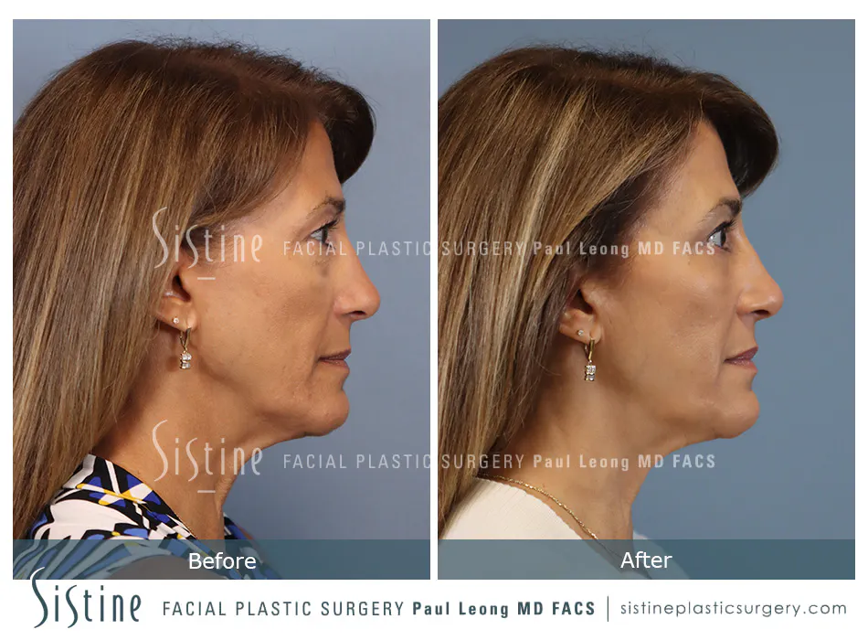 Blepharoplasty Before and After | Leong Facial Plastic Surgery