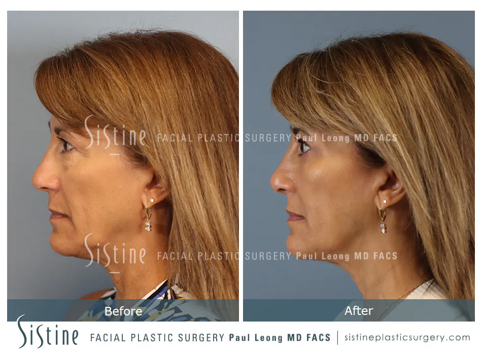 Blepharoplasty Before and After | Leong Facial Plastic Surgery