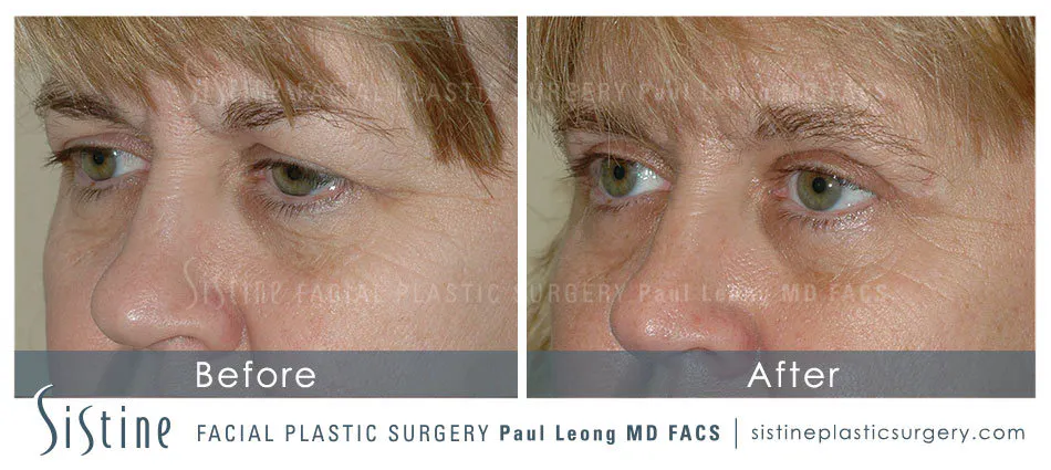 Pittsburgh PA Blepharoplasty Procedure - Preoperative Right Oblique View | Dr. Paul Leong