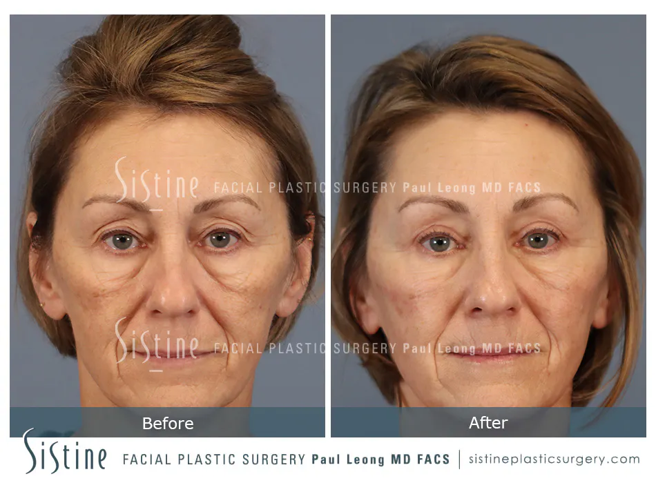 Blepharoplasty Before and After | Leong Facial Plastic Surgery