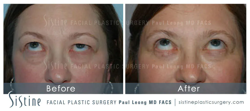 Blepharoplasty Before and After | Leong Facial Plastic Surgery