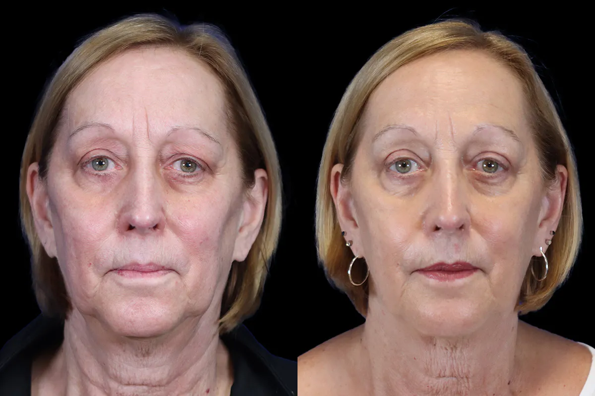 Blepharoplasty Before and After | Leong Facial Plastic Surgery
