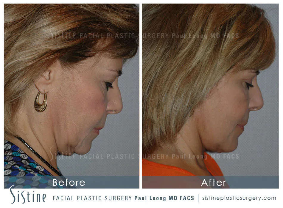 Blepharoplasty Before and After | Leong Facial Plastic Surgery