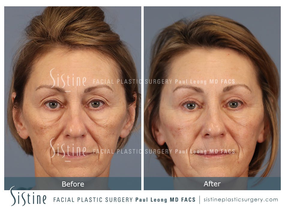 Blepharoplasty Before and After | Leong Facial Plastic Surgery