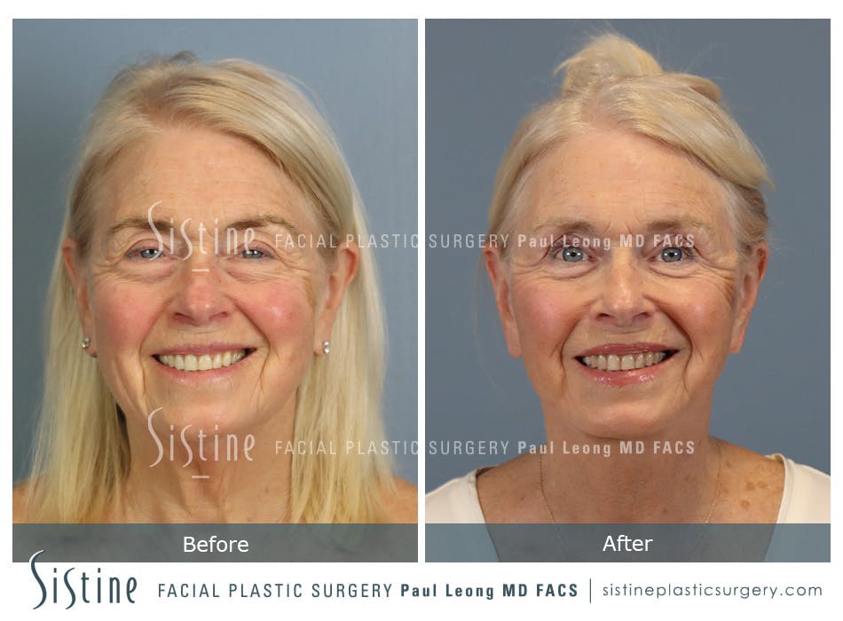 Blepharoplasty Before and After | Leong Facial Plastic Surgery