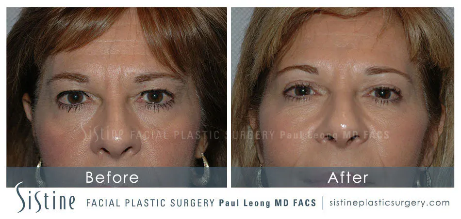 Blepharoplasty Before and After | Leong Facial Plastic Surgery