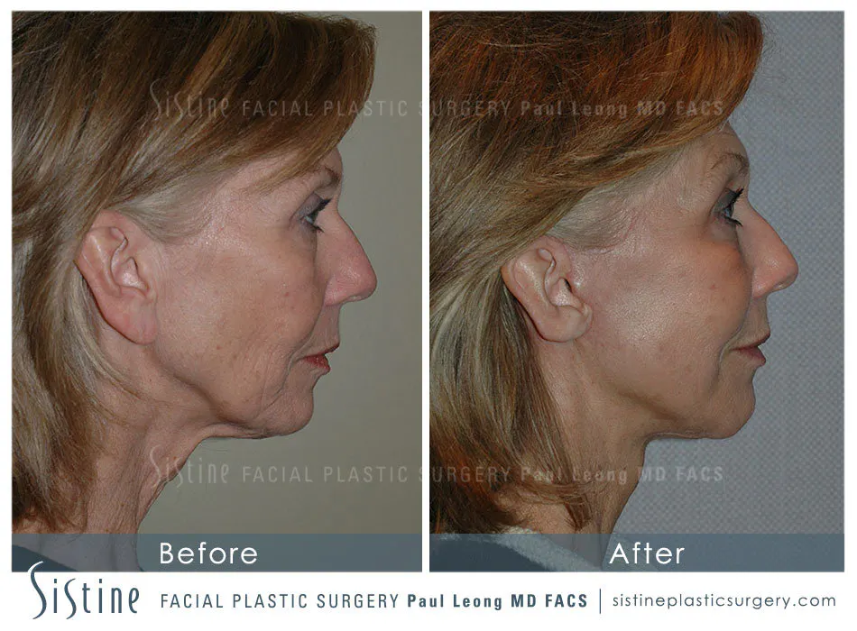 Blepharoplasty Before and After | Leong Facial Plastic Surgery