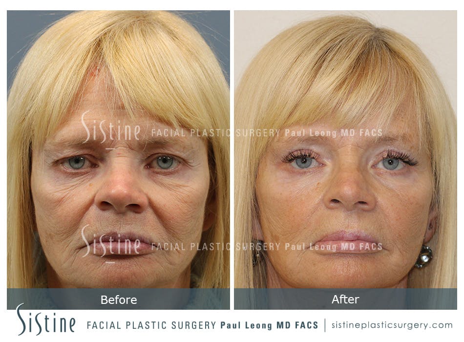 Blepharoplasty Before and After | Leong Facial Plastic Surgery