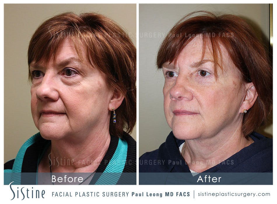 Blepharoplasty Before and After | Leong Facial Plastic Surgery