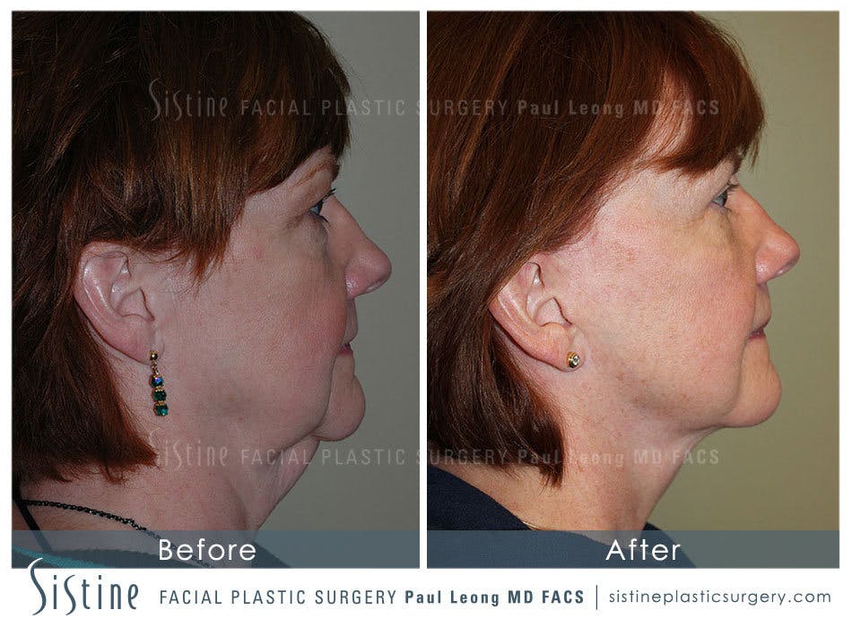 Blepharoplasty Before and After | Leong Facial Plastic Surgery