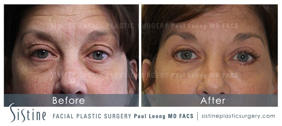 Blepharoplasty Before and After | Leong Facial Plastic Surgery
