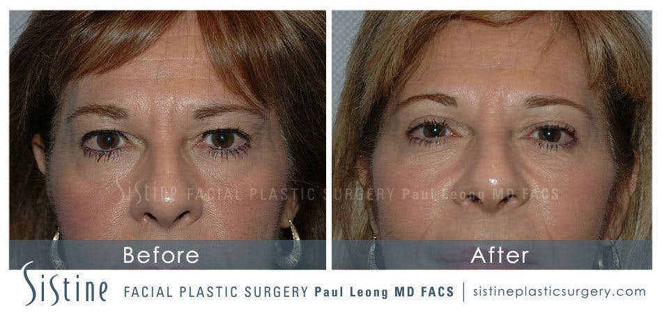 Blepharoplasty Before and After | Leong Facial Plastic Surgery