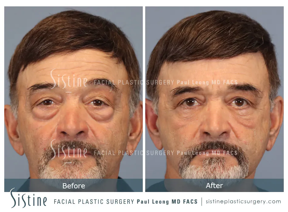 Blepharoplasty Before and After | Leong Facial Plastic Surgery