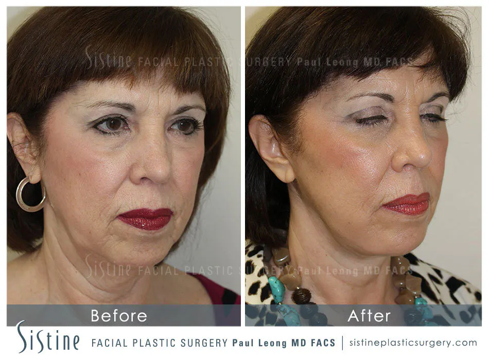 Blepharoplasty Before and After | Leong Facial Plastic Surgery