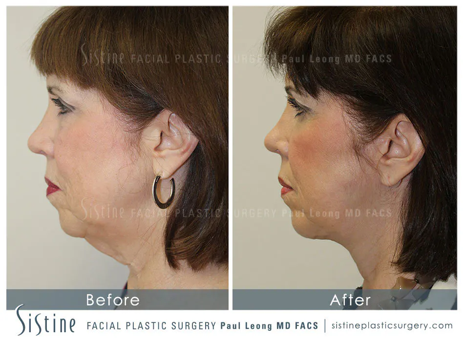 Blepharoplasty Before and After | Leong Facial Plastic Surgery