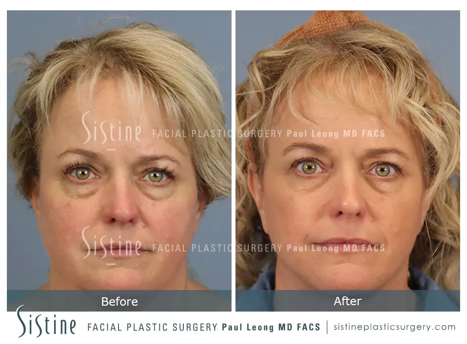 Blepharoplasty Before and After | Leong Facial Plastic Surgery