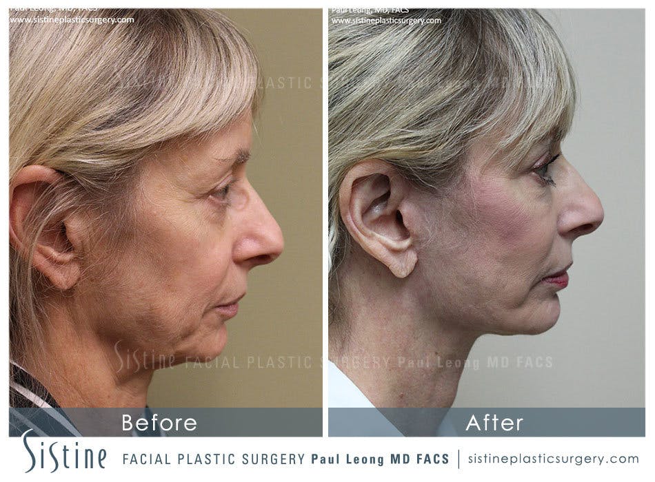 Blepharoplasty Before and After | Leong Facial Plastic Surgery
