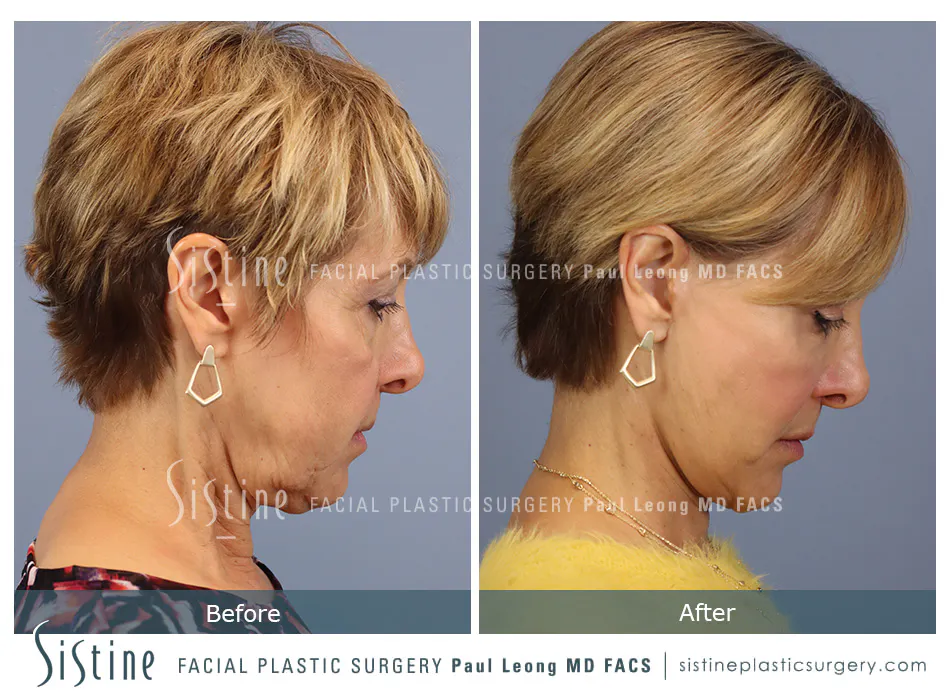 Pittsburgh High SMAS Facelift - Preoperative Left Later Chin Tucked View  Sistine Facial Plastic Surgery