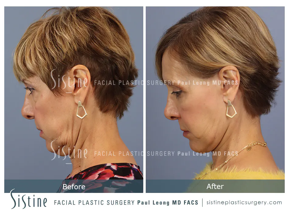 Pittsburgh High SMAS Facelift - Preoperative Left Later Chin Tucked View  Sistine Facial Plastic Surgery