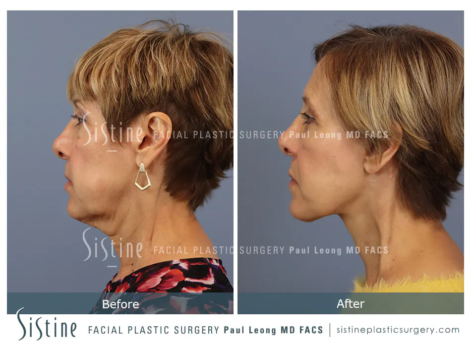 Pittsburgh High SMAS Facelift - Preoperative Left Later Chin Tucked View  Sistine Facial Plastic Surgery