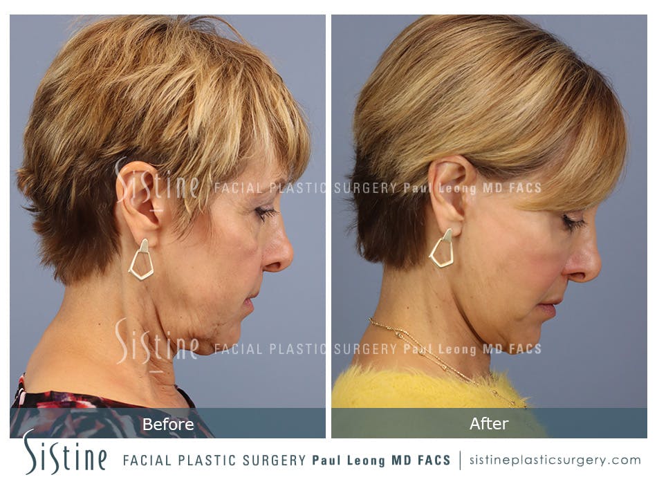 Blepharoplasty Before and After | Leong Facial Plastic Surgery