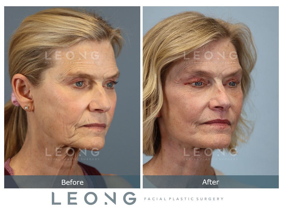 Browlift Before and After | Leong Facial Plastic Surgery
