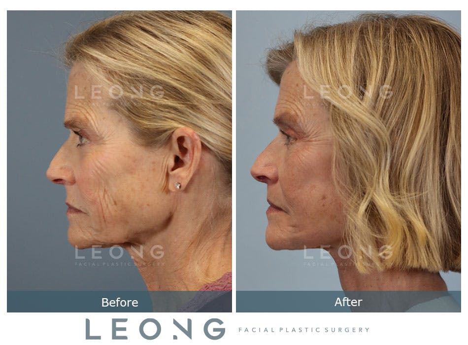 Browlift Before and After | Leong Facial Plastic Surgery