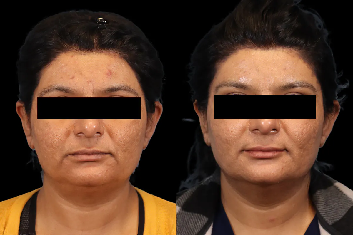Browlift Before and After | Leong Facial Plastic Surgery