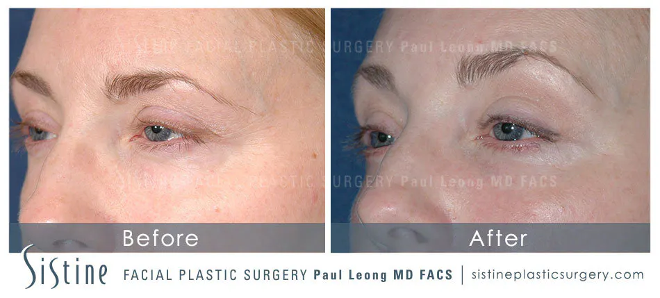 Browlift Before and After | Leong Facial Plastic Surgery
