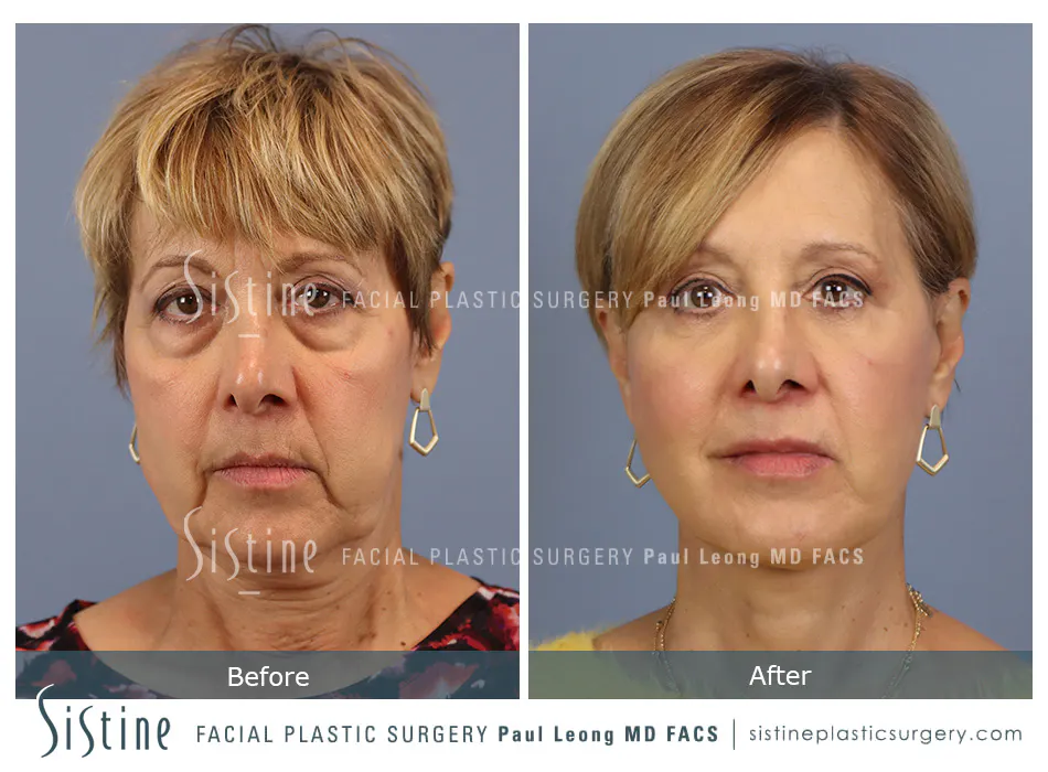 High SMAS Facelift in Pittsburgh - Preoperative Frontal View | Sistine Facial Plastic Surgery