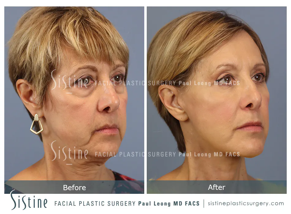 Pittsburgh High SMAS Facelift - Preoperative Left Oblique View | Sistine Facial Plastic Surgery