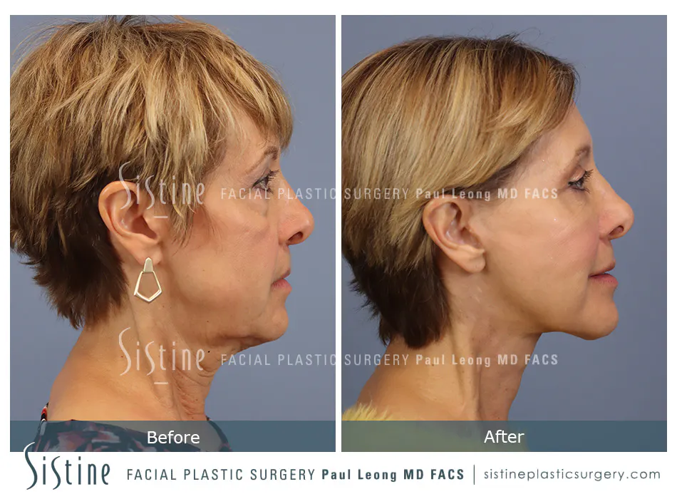 Pittsburgh High SMAS Facelift - Preoperative Right Lateral View | Sistine Facial Plastic Surgery