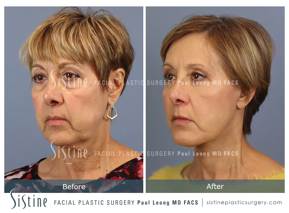 Pittsburgh High SMAS Facelift - Preoperative Right Oblique View | Sistine Facial Plastic Surgery
