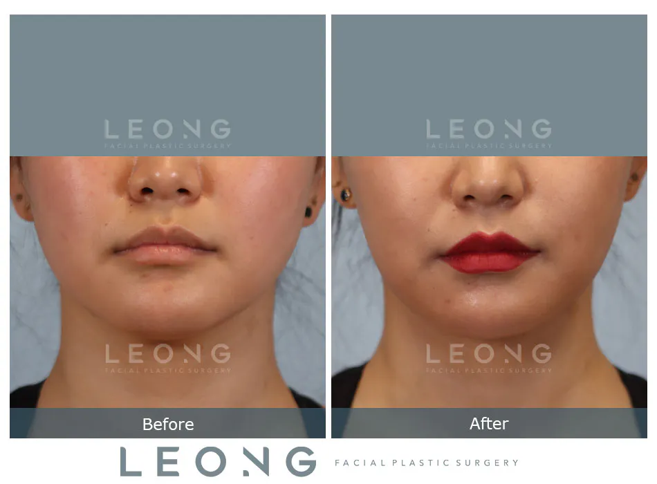 Buccal Fat Removal Before and After | Leong Facial Plastic Surgery