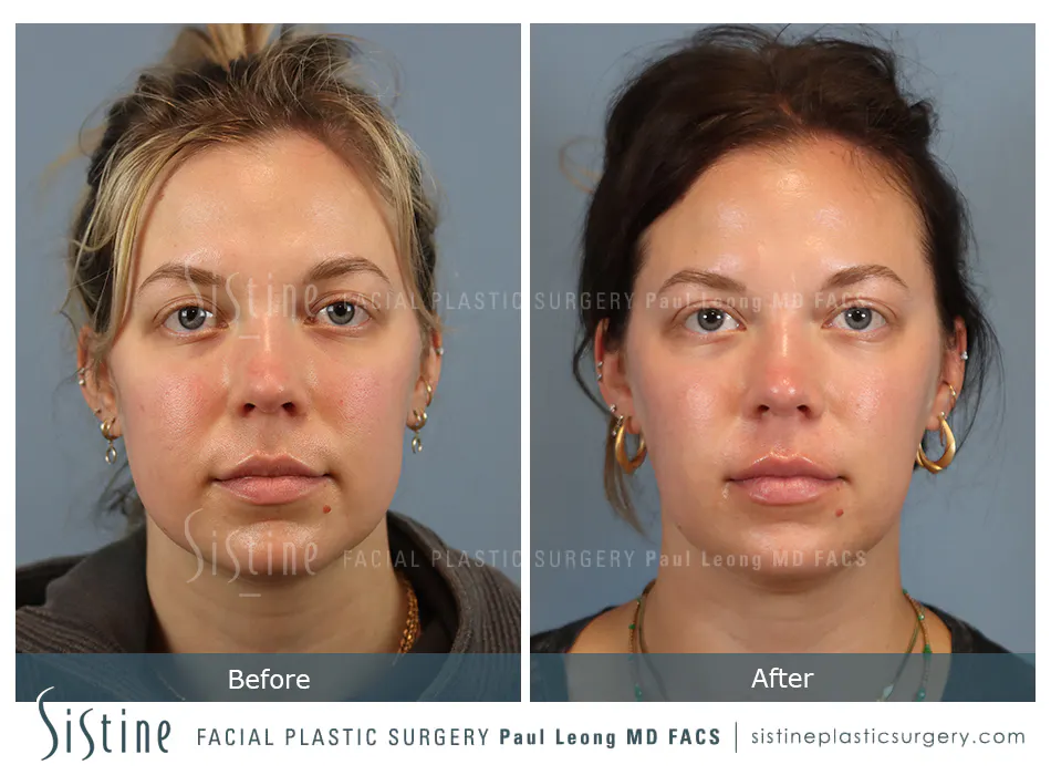 Buccal Fat Removal Before and After | Leong Facial Plastic Surgery