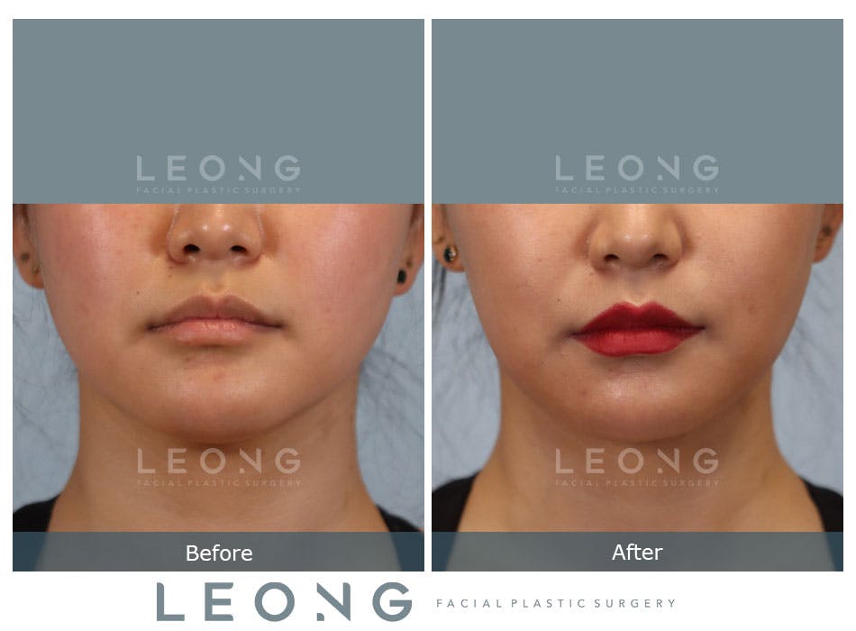 Buccal Fat Removal Before and After | Leong Facial Plastic Surgery