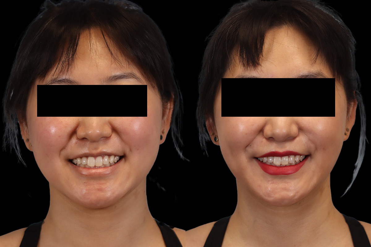 Buccal Fat Removal Before and After | Leong Facial Plastic Surgery