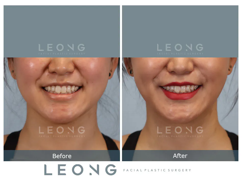 Buccal Fat Removal Before and After | Leong Facial Plastic Surgery