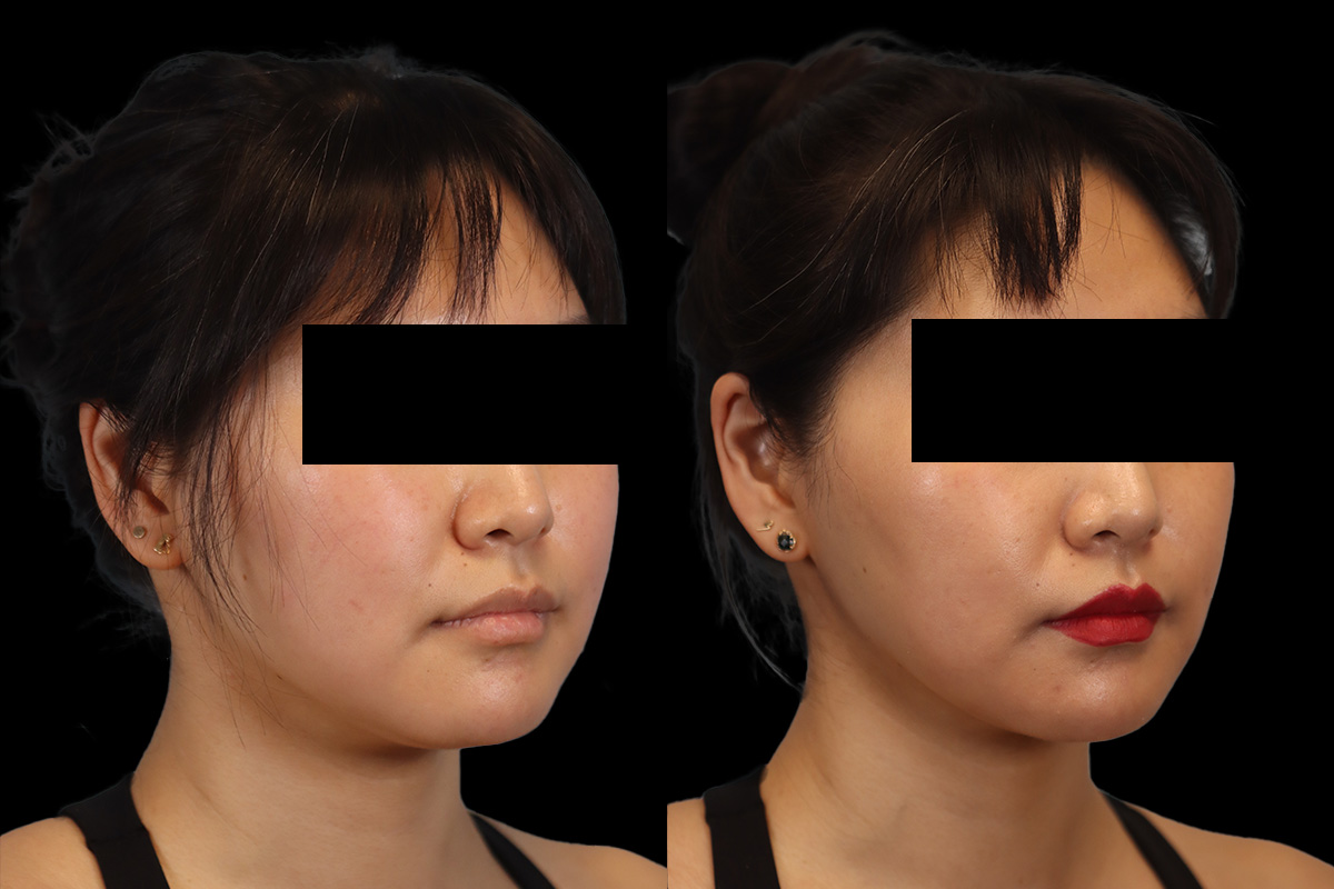 Buccal Fat Removal Before and After | Leong Facial Plastic Surgery