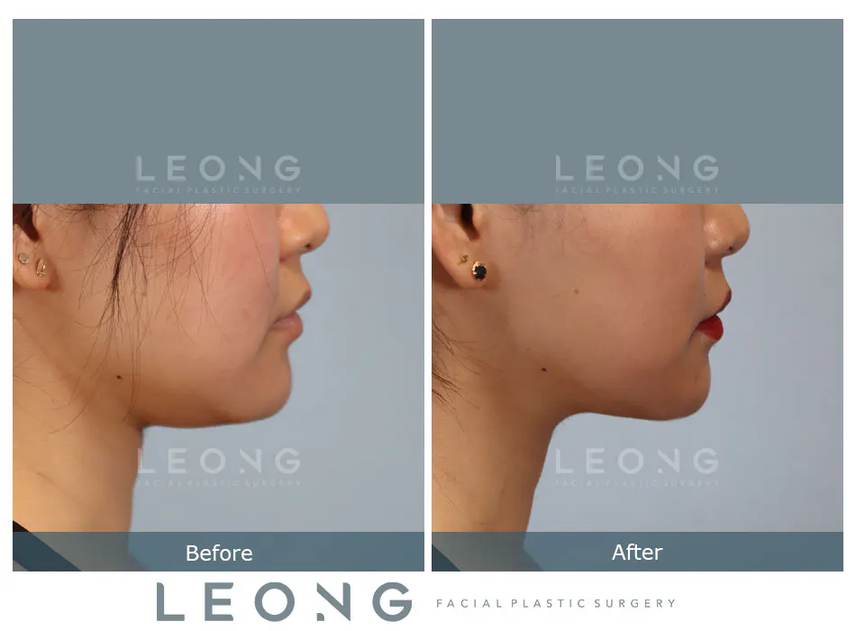 Buccal Fat Removal Before and After | Leong Facial Plastic Surgery