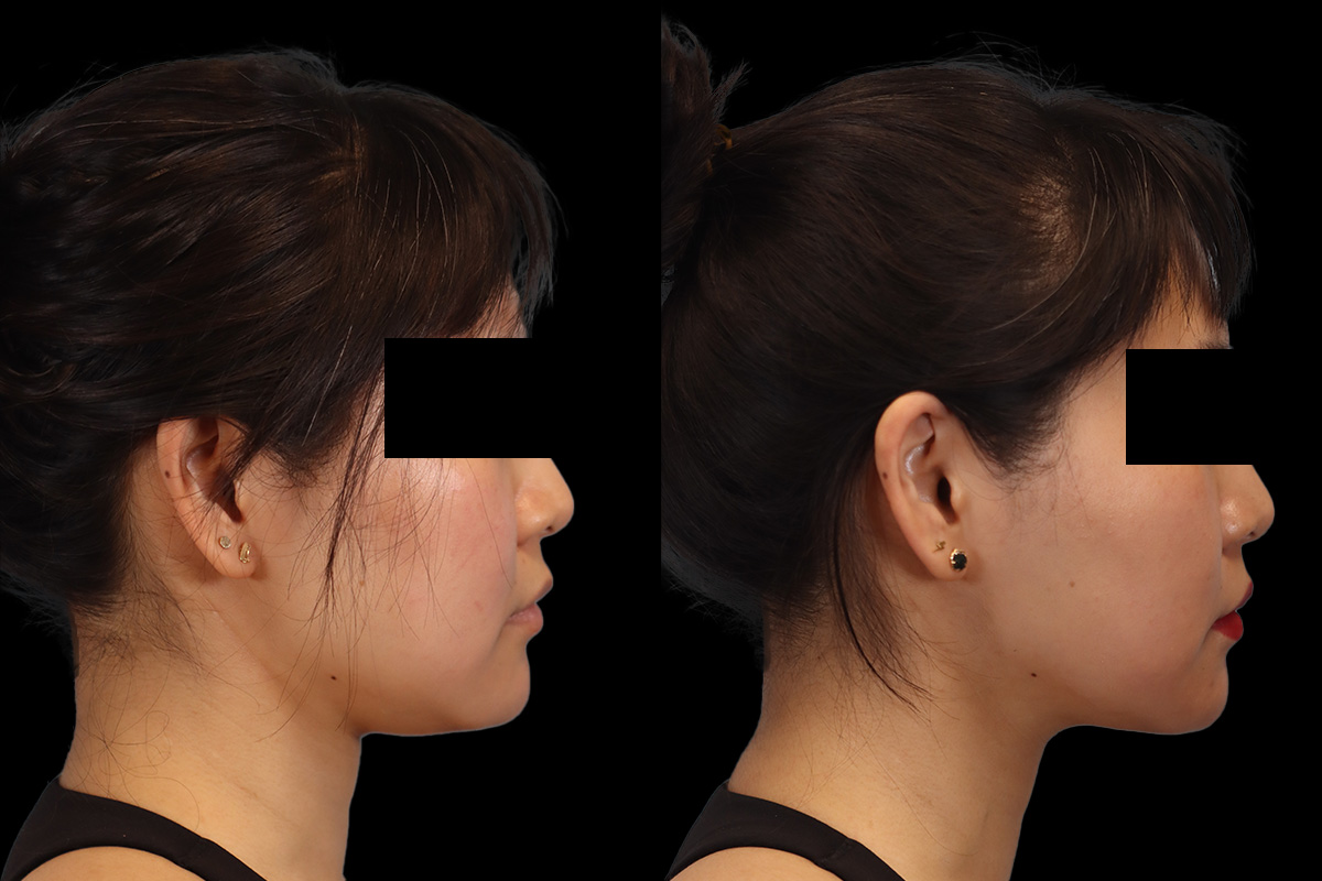 Buccal Fat Removal Before and After | Leong Facial Plastic Surgery