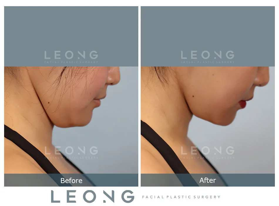 Buccal Fat Removal Before and After | Leong Facial Plastic Surgery