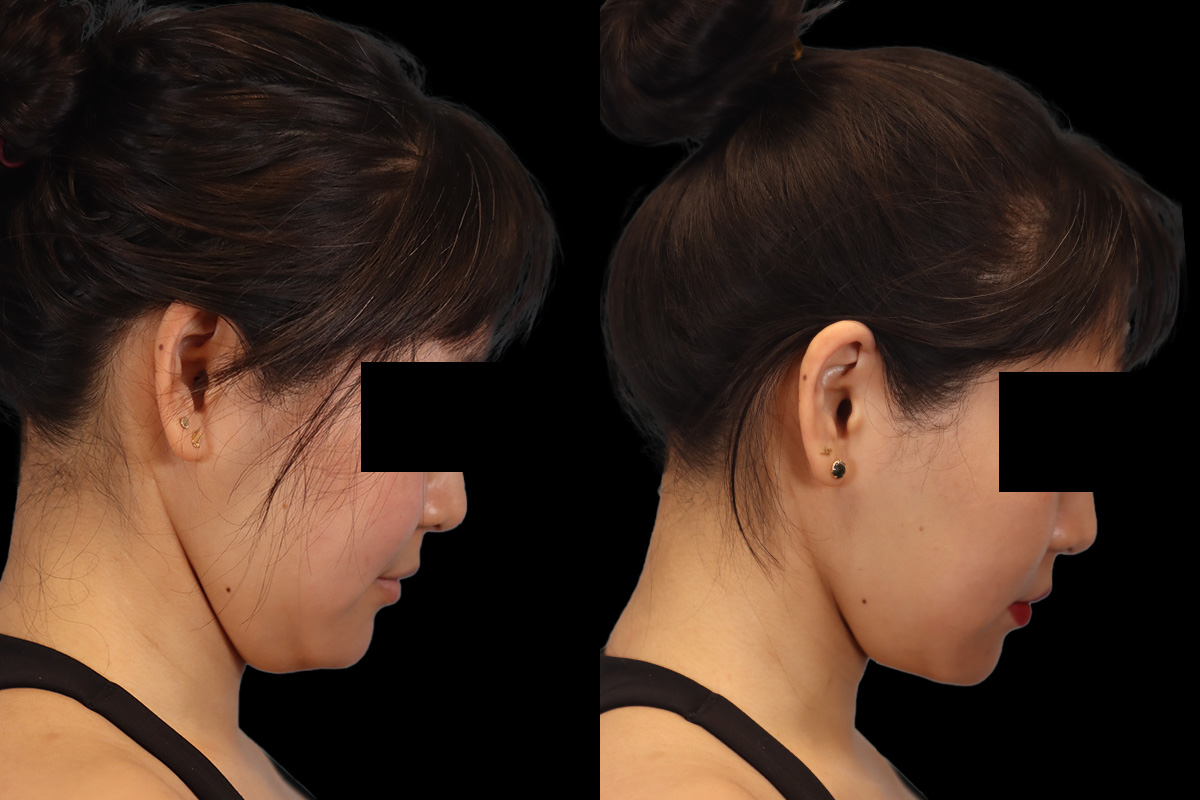 Buccal Fat Removal Before and After | Leong Facial Plastic Surgery