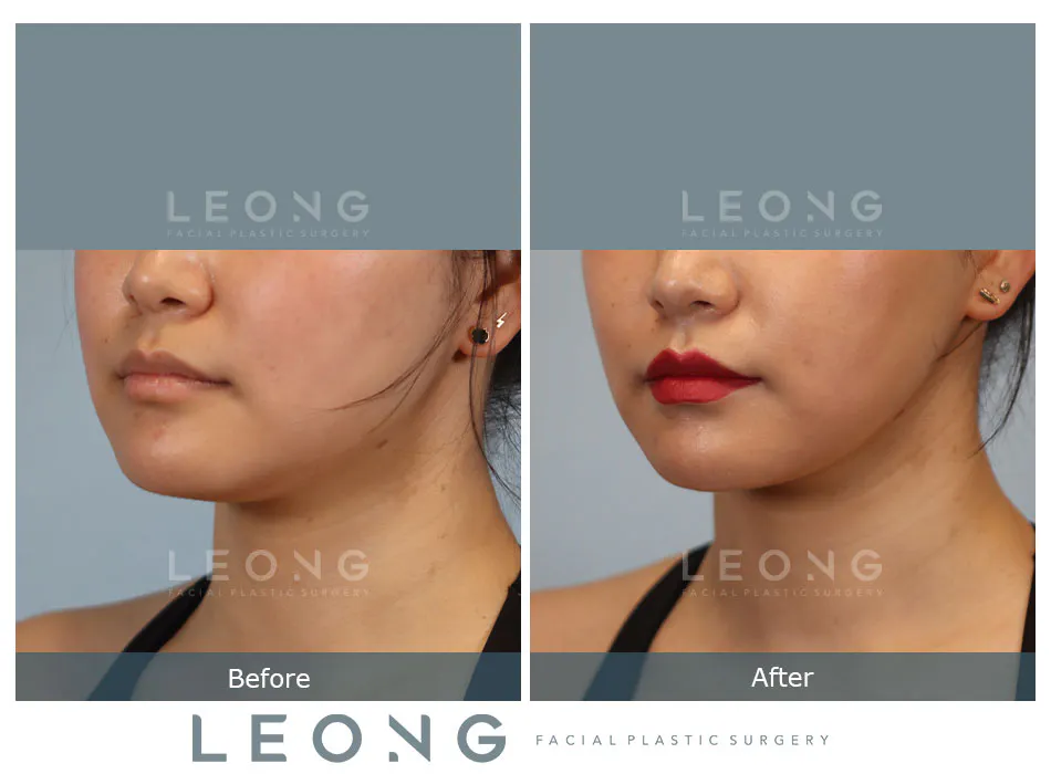Buccal Fat Removal Before and After | Leong Facial Plastic Surgery