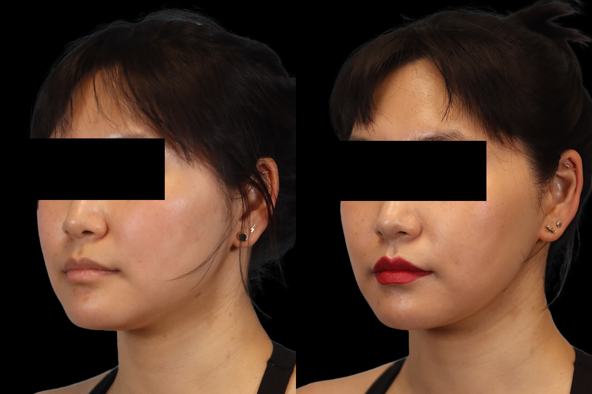 Buccal Fat Removal Before and After | Leong Facial Plastic Surgery