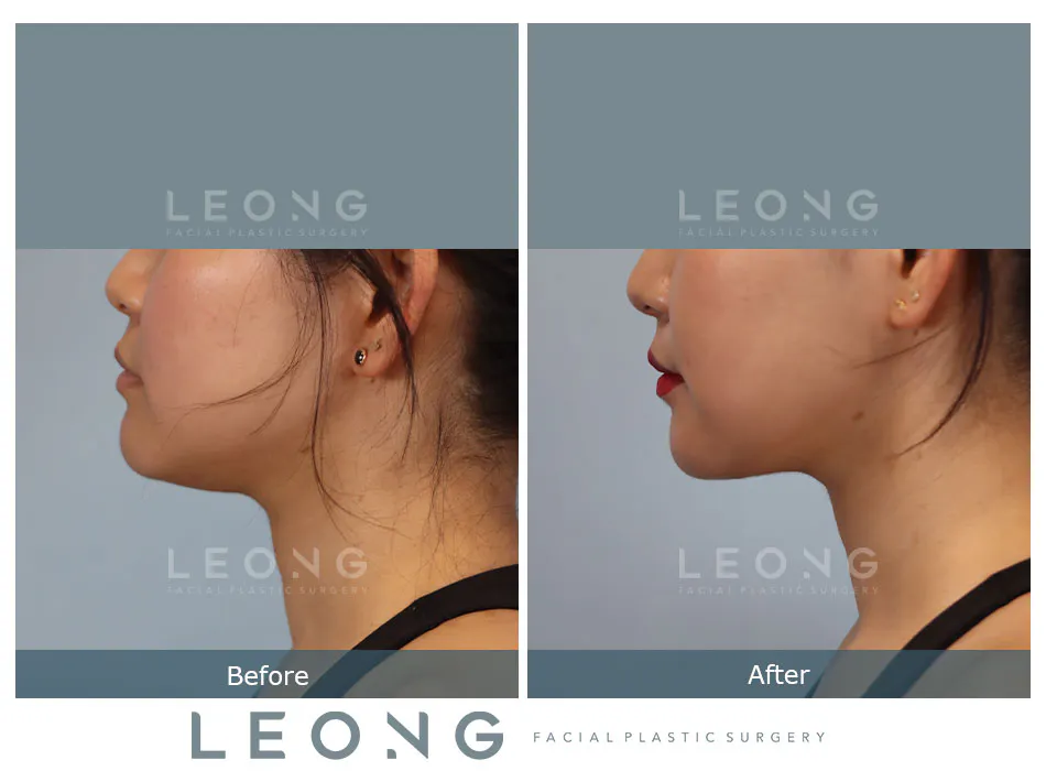 Buccal Fat Removal Before and After | Leong Facial Plastic Surgery