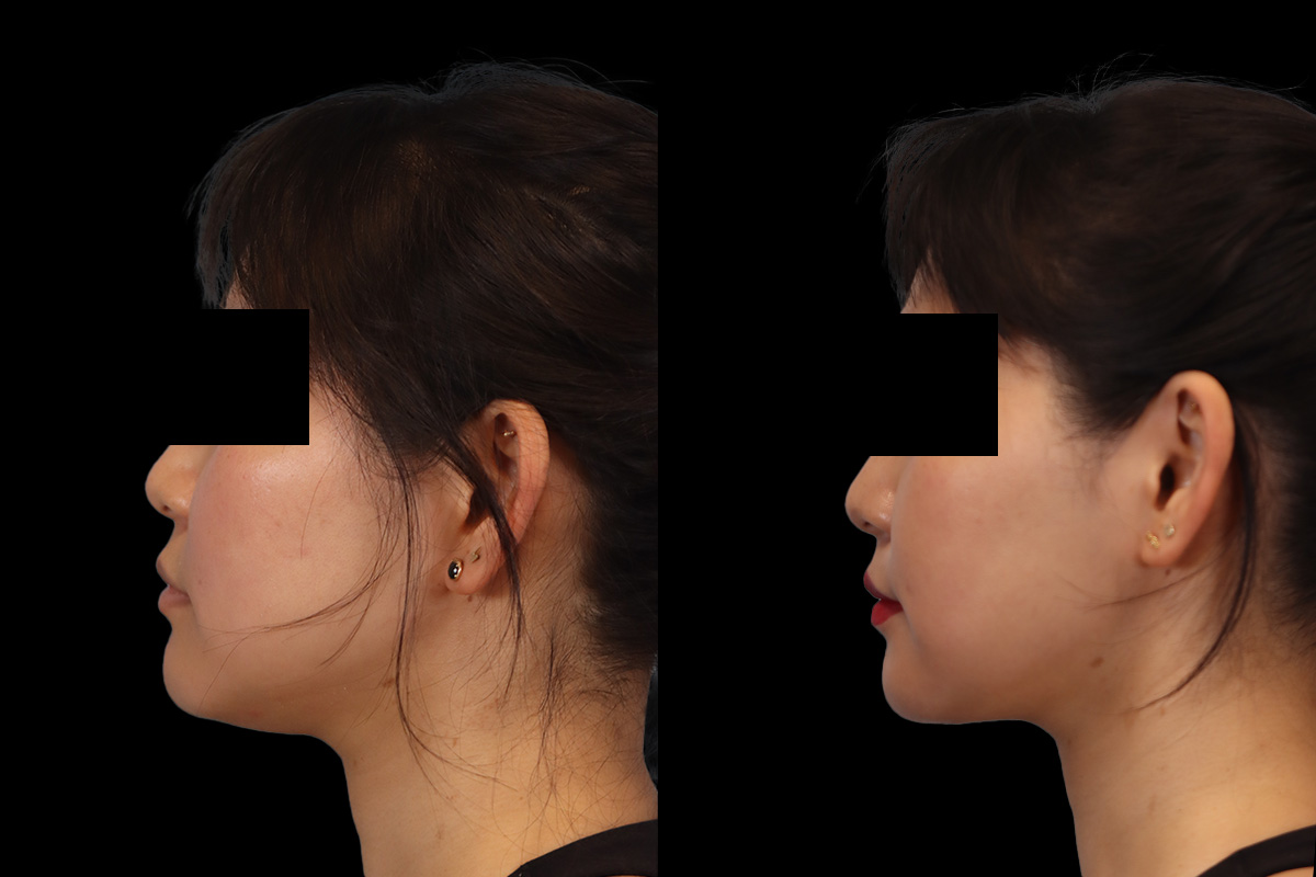 Buccal Fat Removal Before and After | Leong Facial Plastic Surgery