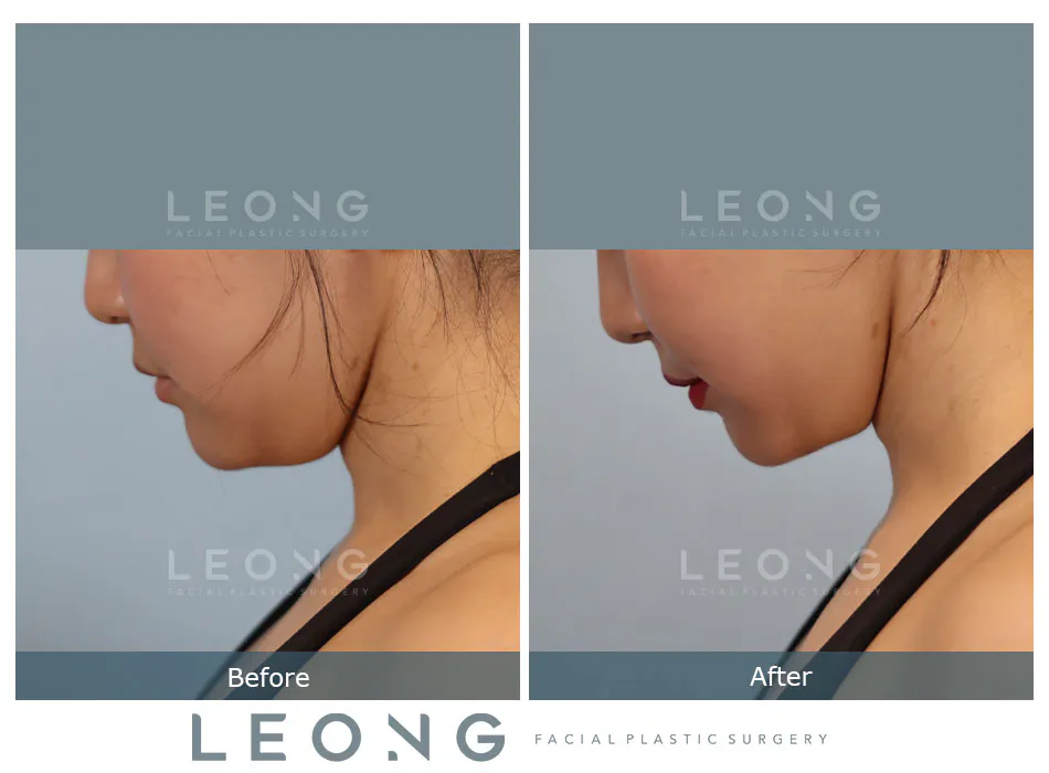 Buccal Fat Removal Before and After | Leong Facial Plastic Surgery
